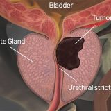 Scientists Develop Experimental Drug to Slow Aggressive Prostate Cancer