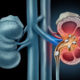 Diet, Hydration Can Help Lower Kidney Stone Risk, Experts Say